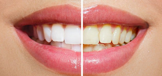 t روش‌های اصولی برای سفید کردن دندان!